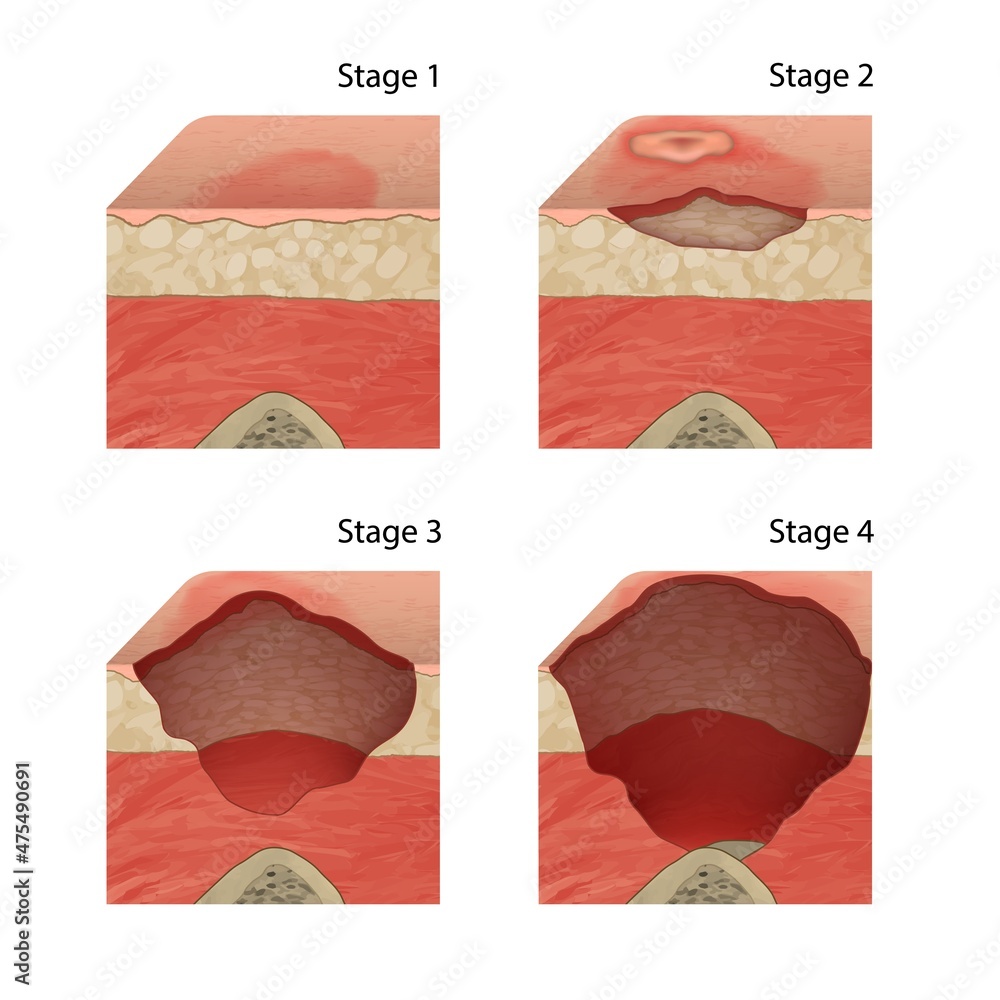 Advanced Wound Care Centers In Hyderabad